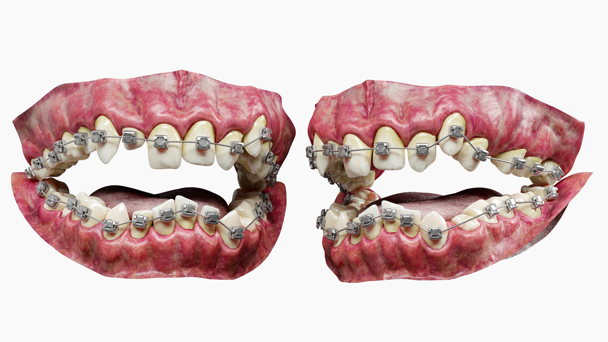 3D Teeth models